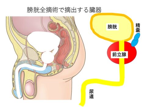 尿路上皮癌3