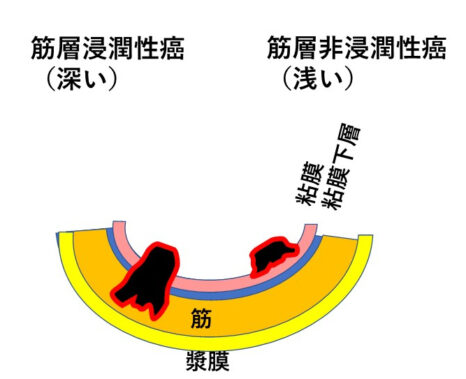 尿路上皮癌2