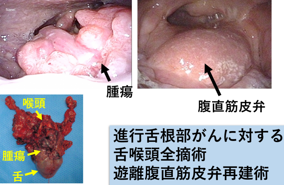 中咽頭がん3