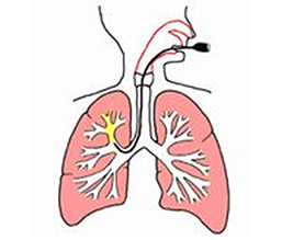 気管支鏡による気管、気管支内の観察