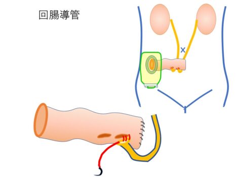 尿路上皮癌4