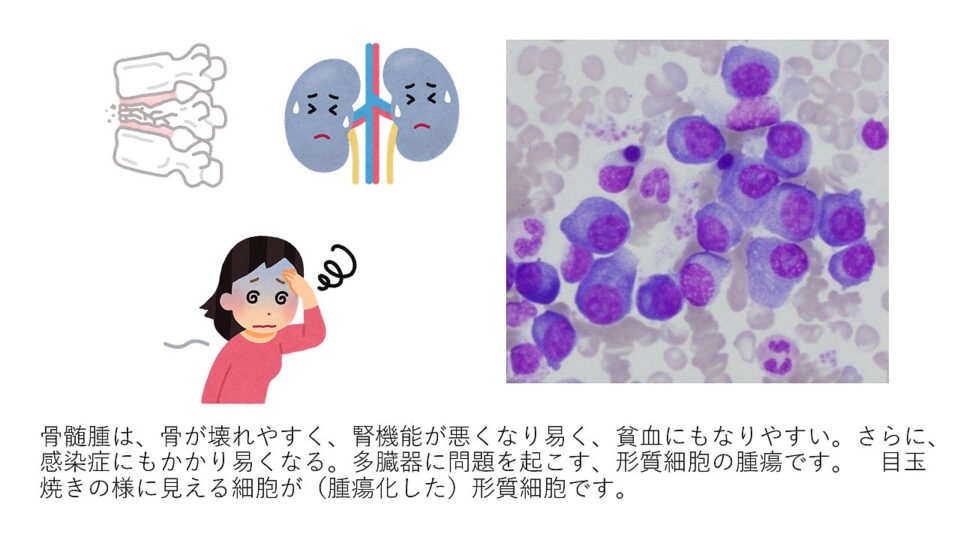 多発性骨髄腫