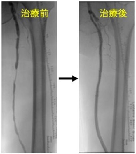 カテーテル治療2