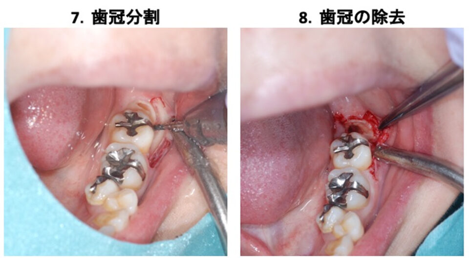 埋伏歯4