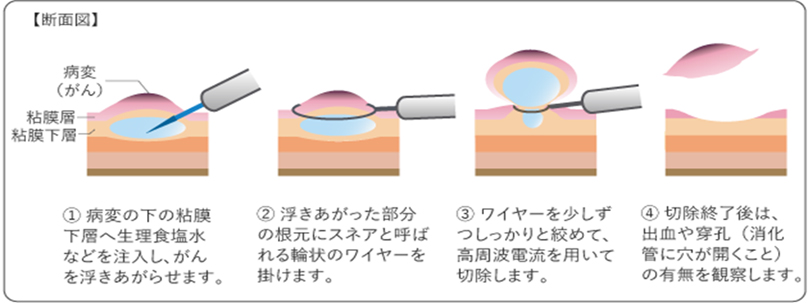 内視鏡的粘膜切除術(EMR)