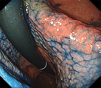 内視鏡的粘膜下層隔離術(胃癌)