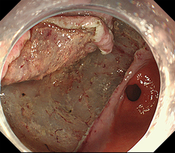 内視鏡的粘膜下層隔離術(胃癌)
