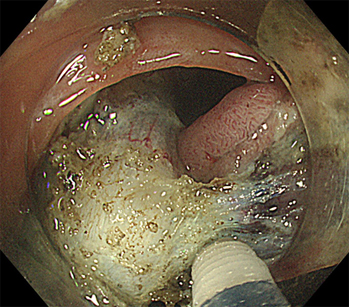 内視鏡的粘膜下層隔離術(横行結腸)