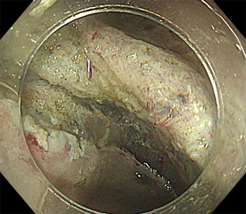 内視鏡的粘膜下層隔離術(横行結腸)