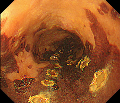 内視鏡的粘膜下層隔離術(食道癌)