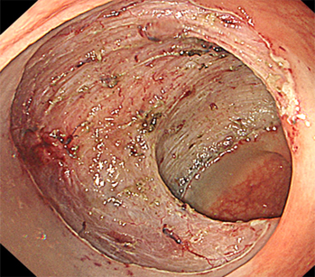 内視鏡的粘膜下層隔離術(直腸)