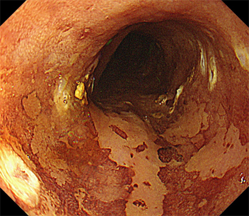 内視鏡的粘膜下層隔離術(食道癌)